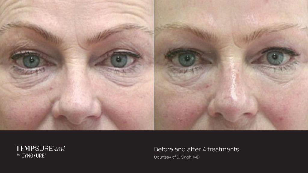 A before and after image of 4 botox/skin tightening treatments.