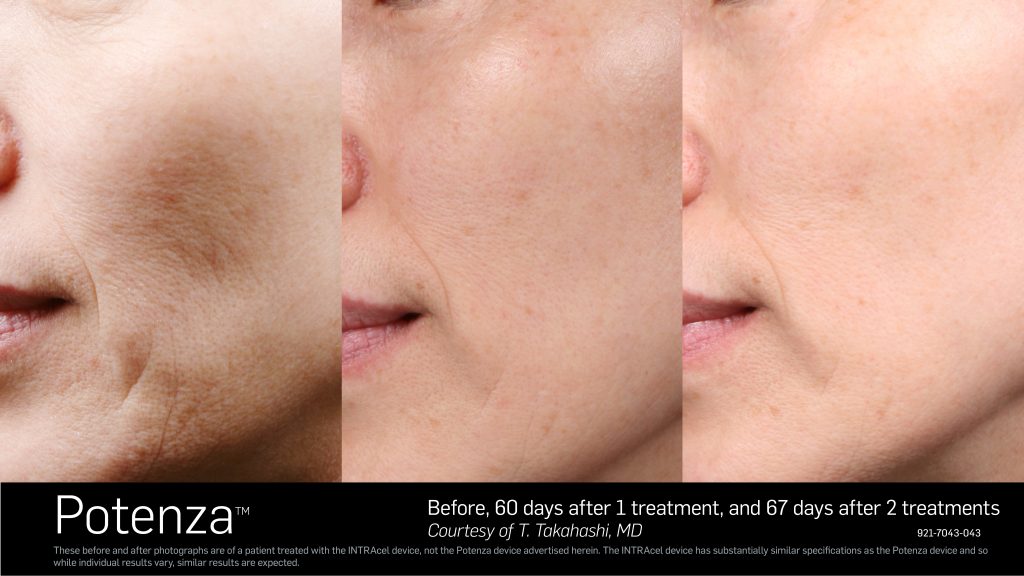 lethbridge botox, stretch marks, skin tightening, laser hair removal, skin care, rejuvenation.